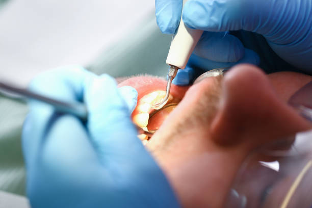 Best Emergency Root Canal Treatment in Mercersburg, PA